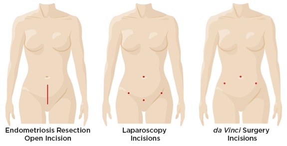da-vinci_endometriosis_resection_incision_comparison
