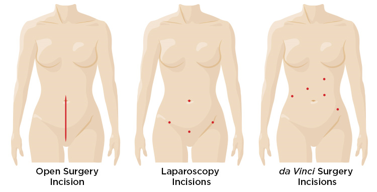 da-vinci_hysterectomy_benign_incision_comparison