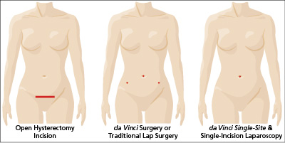 hysterectomy-incision-comparison-single-site